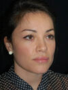 Facial Fat Grafting case #4519