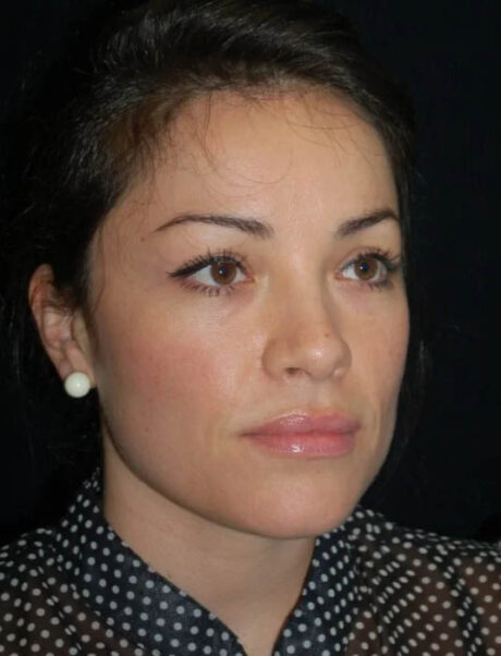 Facial Fat Grafting case #4519
