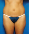 Liposuction case #4699