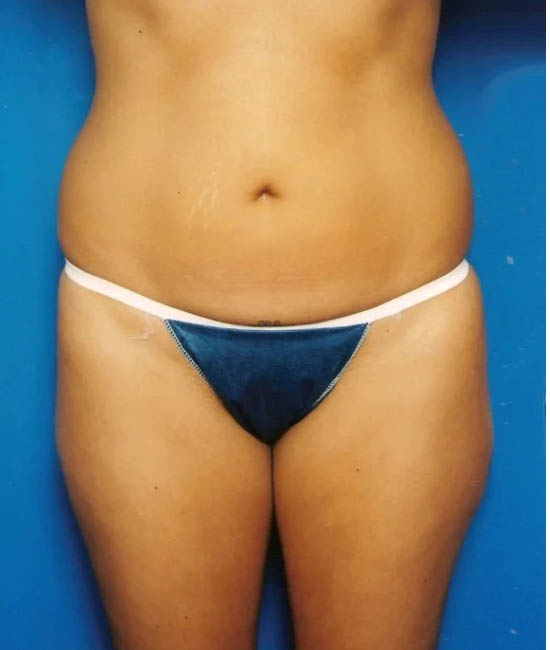 Liposuction case #4699