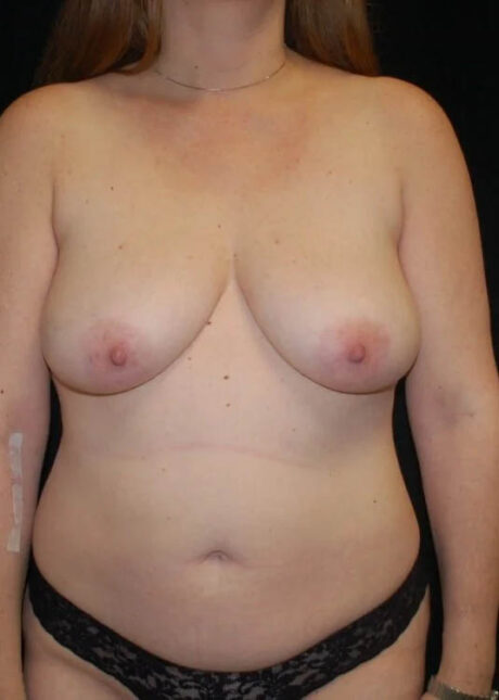 Breast Augmentation with Full Lift case #3947