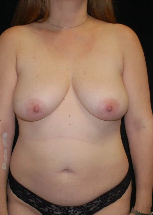 Breast Augmentation with Full Lift case #3947