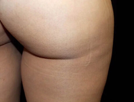Coolsculpting case #4328