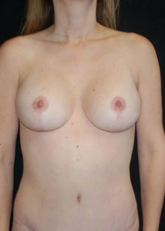 Breast Augmentation with Full Lift case #3947