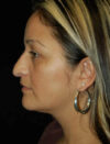 Facial Fat Grafting case #4527