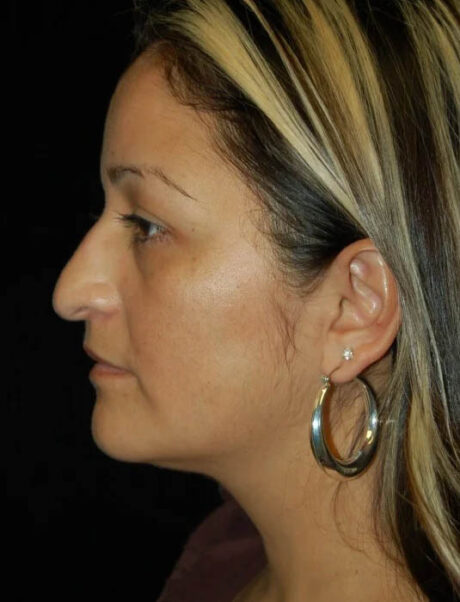 Facial Fat Grafting case #4527