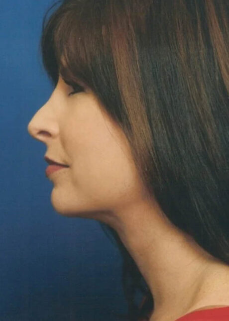 Chin Implant case #4212