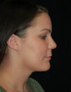 Neck Liposuction case #4964