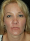 Buccal Fat Removal case #4142