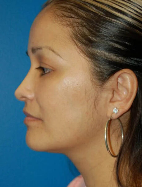 Facial Fat Grafting case #4527