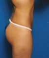 Liposuction case #4699