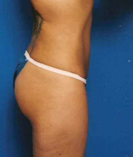 Liposuction case #4699
