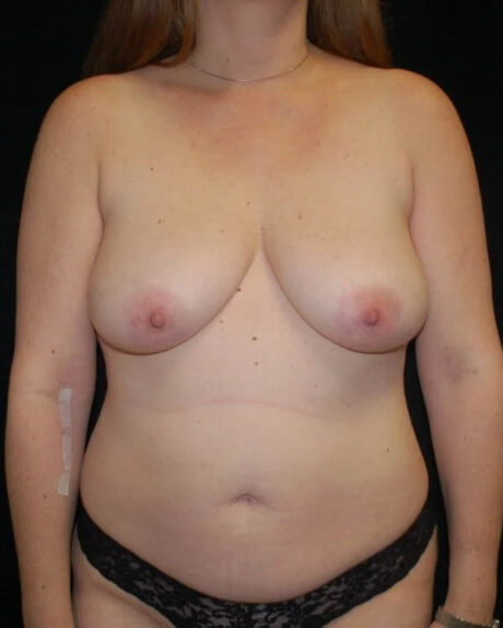 Mommy Makeover case #4850