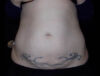 Coolsculpting case #4333