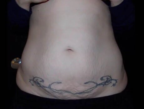 Coolsculpting case #4333
