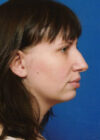 Chin Implant case #4219