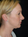 Neck Liposuction case #4967
