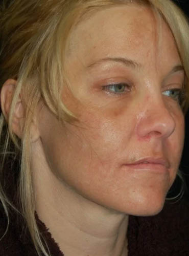 Buccal Fat Removal case #4142