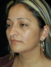 Facial Fat Grafting case #4527
