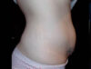 Coolsculpting case #4333