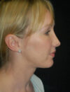 Neck Liposuction case #4967
