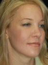 Buccal Fat Removal case #4142