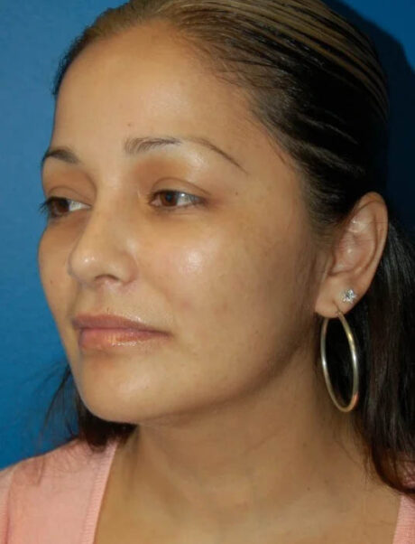 Facial Fat Grafting case #4527