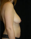 Mommy Makeover case #4850