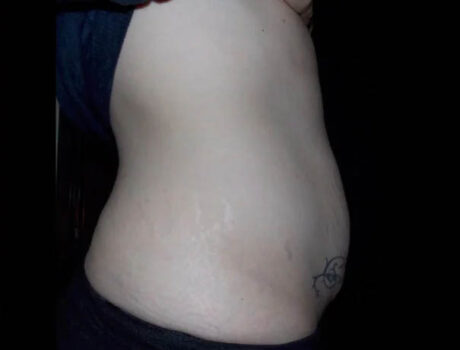 Coolsculpting case #4333