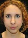 Buccal Fat Removal case #4147