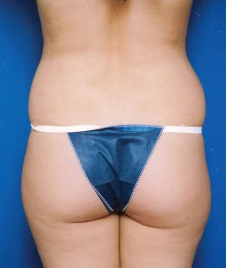 Liposuction case #4706