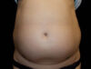 Coolsculpting case #4338