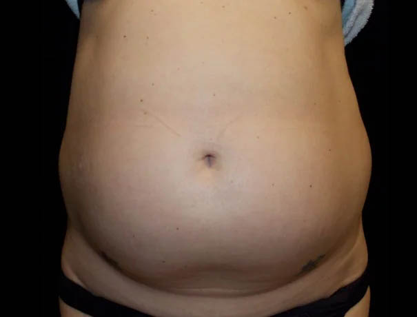 Coolsculpting case #4338