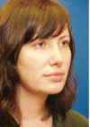 Chin Implant case #4219