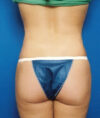 Liposuction case #4706