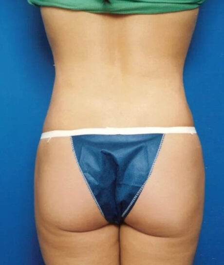 Liposuction case #4706