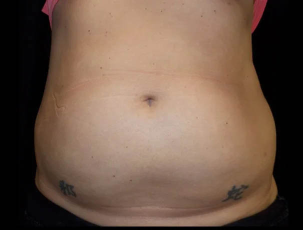 Coolsculpting case #4338