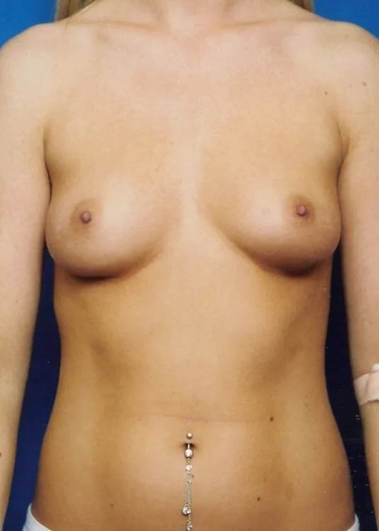 Breast Augmentation case #3663