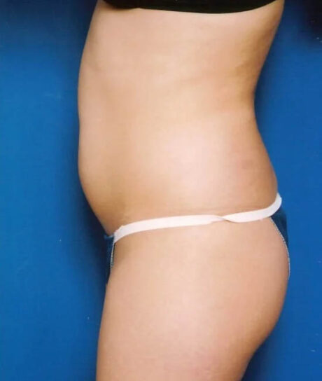 Liposuction case #4706