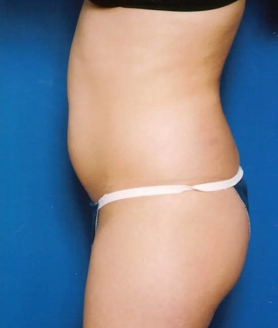 Liposuction case #4706