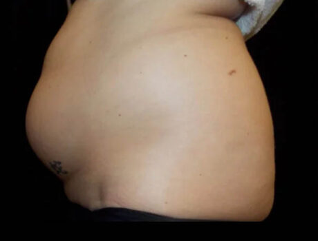 Coolsculpting case #4338