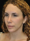 Buccal Fat Removal case #4147