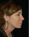 Neck Liposuction case #4973