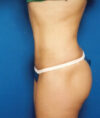 Liposuction case #4706