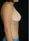 Breast Augmentation with Full Lift case #3954