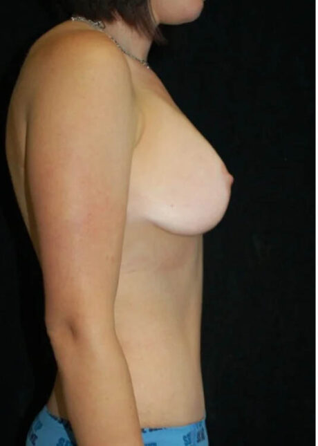 Breast Augmentation with Full Lift case #3954