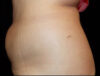 Coolsculpting case #4338