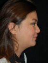 Neck Liposuction case #4976