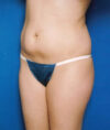 Liposuction case #4706