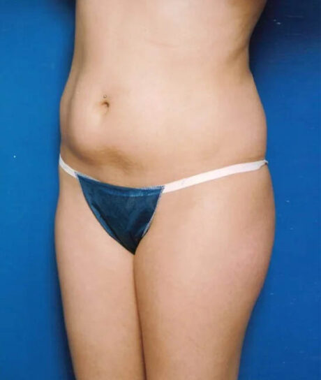 Liposuction case #4706